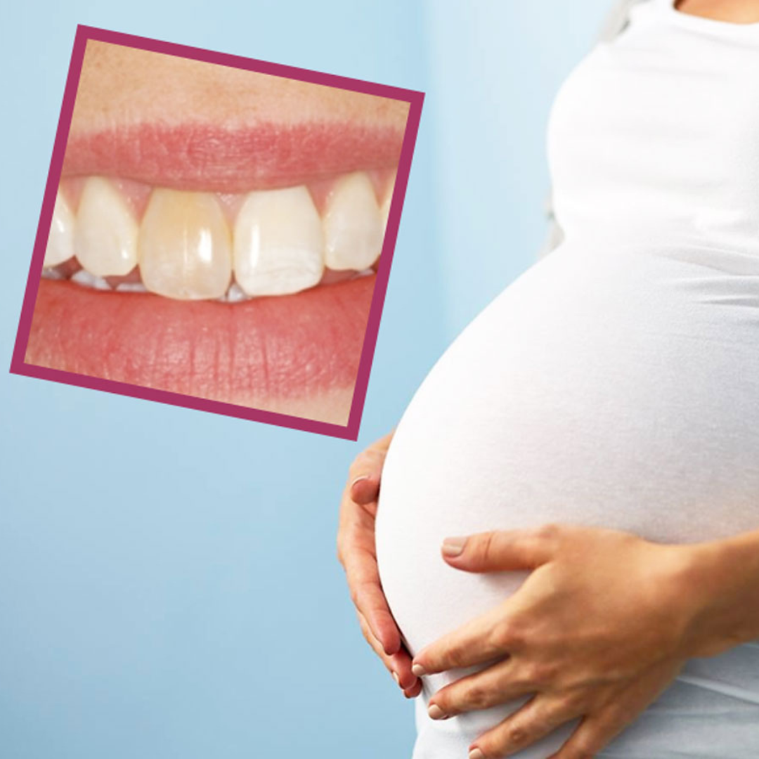 Teeth whitening during pregnancy: Is it safe?