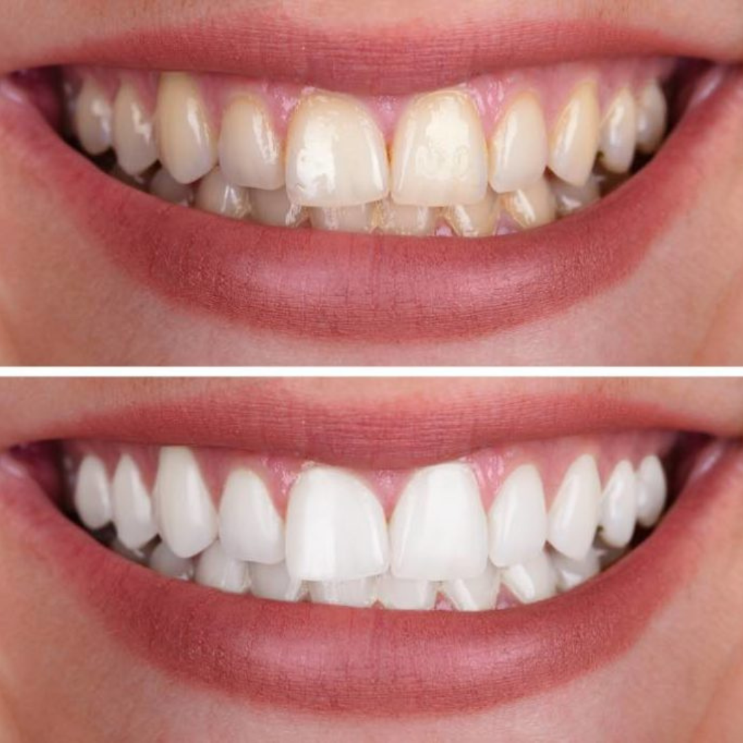 Extra-Strength Teeth Whitening Serum
